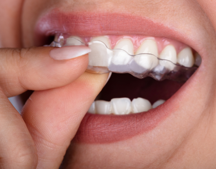Капы 3D Smile